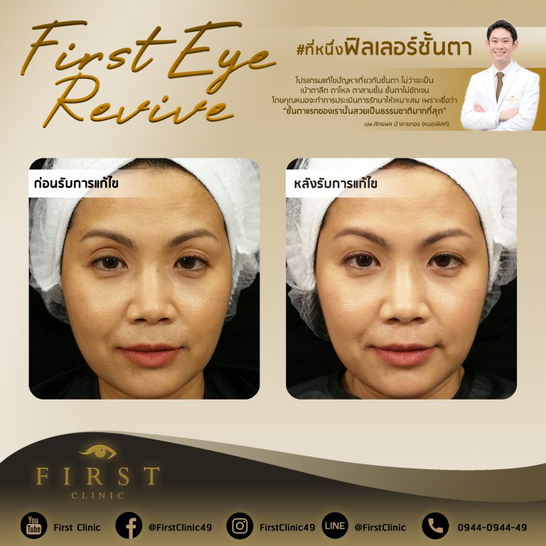 First Eye Revive แก้ไขฟิลเลอร์ตา - First Clinic