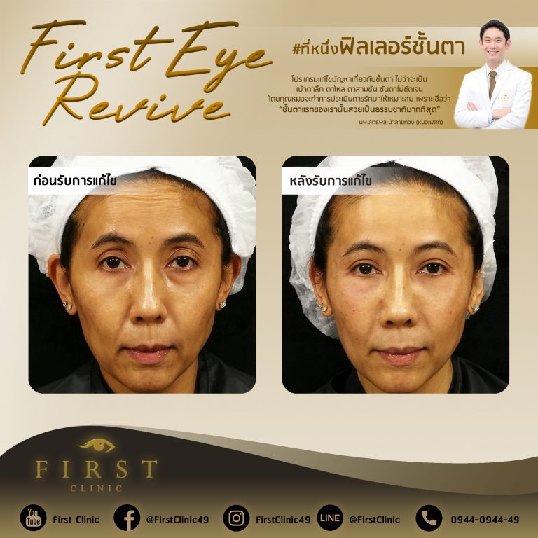 First Eye Revive แก้ไขฟิลเลอร์ตา - First Clinic