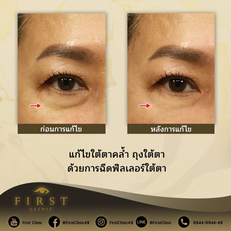 แก้ไขใต้ตาคล้ำ ถุงใต้ตา ด้วยการฉีดฟิลเลอร์ใต้ตา - First Clinic