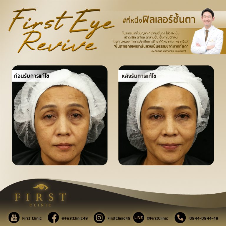 First Eye Revive แก้ไขฟิลเลอร์ตา - First Clinic