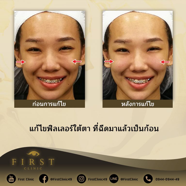 แก้ไขฟิลเลอร์ใต้ตา ที่ฉีดมาแล้วเป็นก้อน - First Clinic