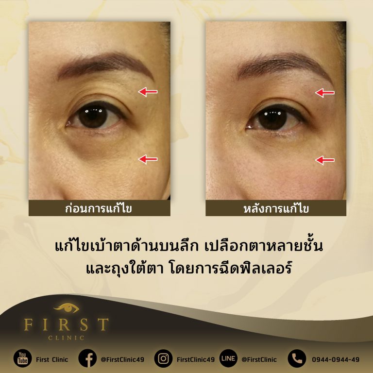 แก้ไขเบ้าตาด้านบนลึก เปลือกตาหลายชั้น และถุงใต้ตา โดยการฉีดฟิลเลอร์ - First Clinic