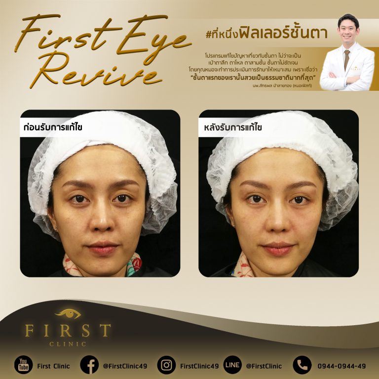 First Eye Revive แก้ไขฟิลเลอร์ตา - First Clinic