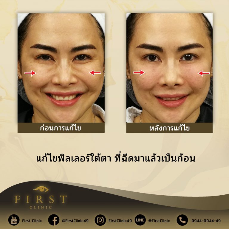 แก้ไขฟิลเลอร์ใต้ตา ที่ฉีดมาแล้วเป็นก้อน - First Clinic