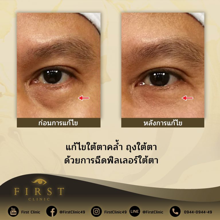 แก้ไขใต้ตาคล้ำ ถุงใต้ตา ด้วยการฉีดฟิลเลอร์ใต้ตา - First Clinic