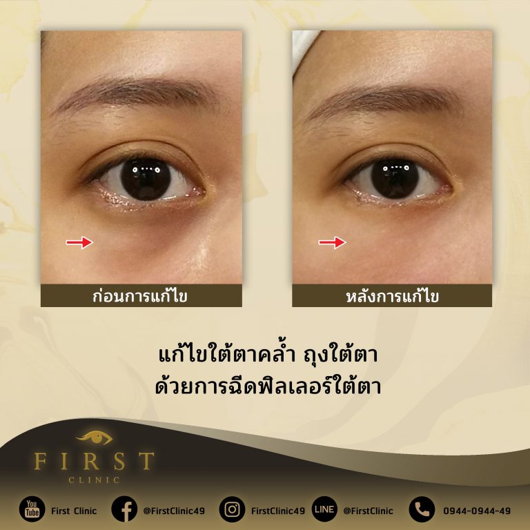 แก้ไขใต้ตาคล้ำ ถุงใต้ตา ด้วยการฉีดฟิลเลอร์ใต้ตา - First Clinic