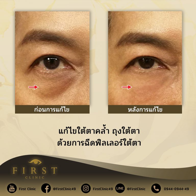 แก้ไขใต้ตาคล้ำ ถุงใต้ตา ด้วยการฉีดฟิลเลอร์ใต้ตา - First Clinic