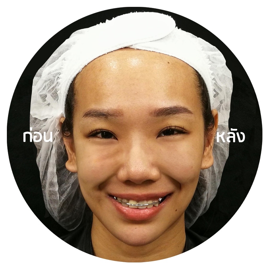 รีวิวฟิลเลอร์ (filler) at First Clinic - First Clinic