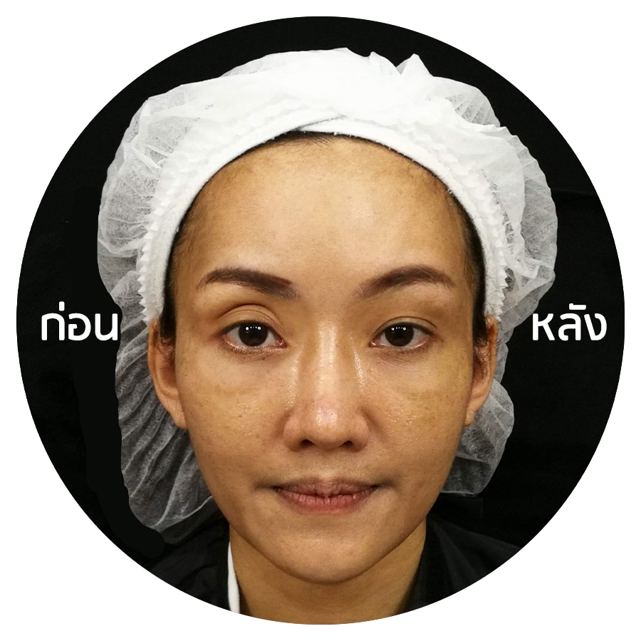 รีวิวแก้ไขฟิลเลอร์ ก่อน&หลัง_First Clinic - First Clinic