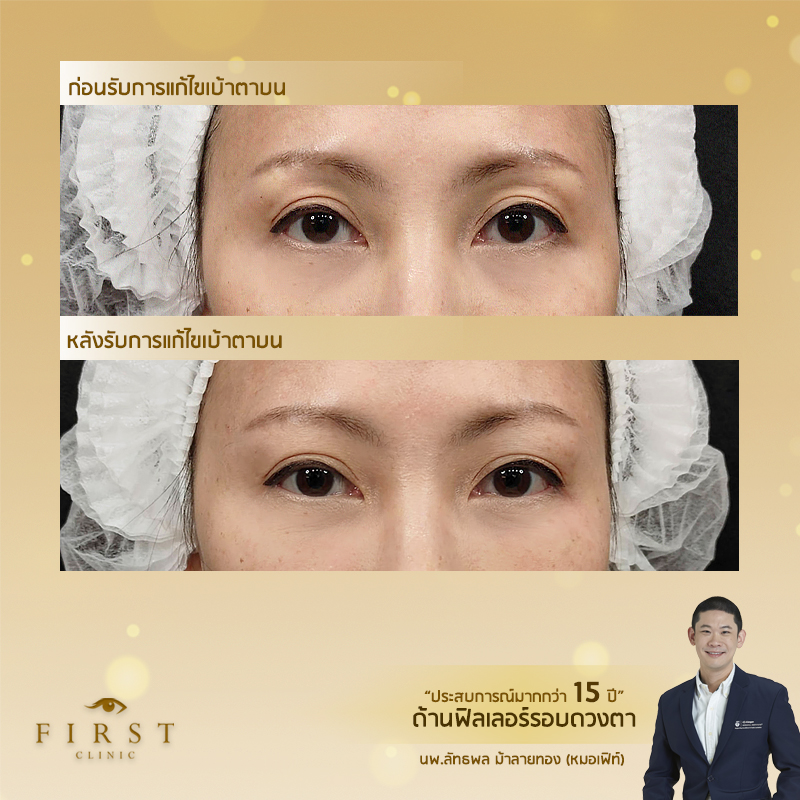 ถามตอบเรื่องฉีดฟิลเลอร์ (Filler) - รีวิวแก้ไขเบ้าตาบน - First Clinic