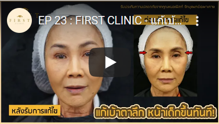 รีวิวตาสองชั้น แก้เบ้าตาลึก หน้าเด็กขึ้นทันที - First Clinic