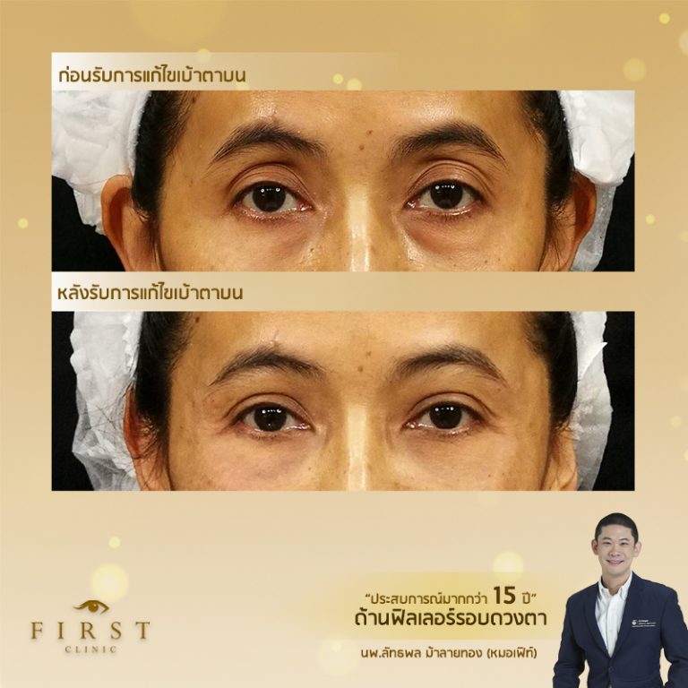 รีวิวทำฟิลเลอร์ตาสองชั้นที่ First Clinic - First Clinic