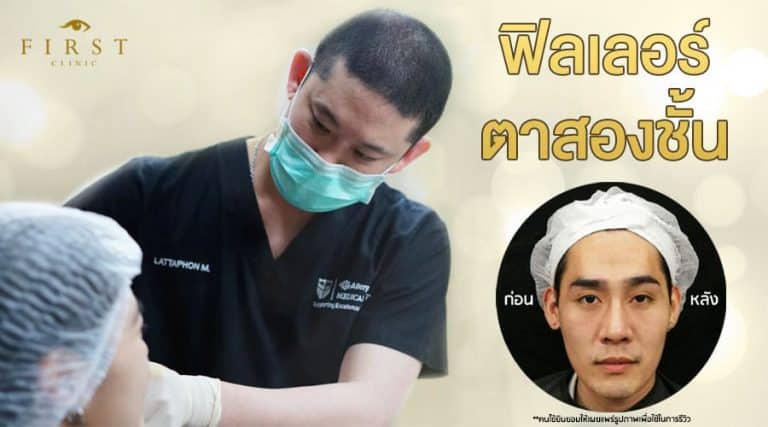 ฟิลเลอตาสองชั้นคือ